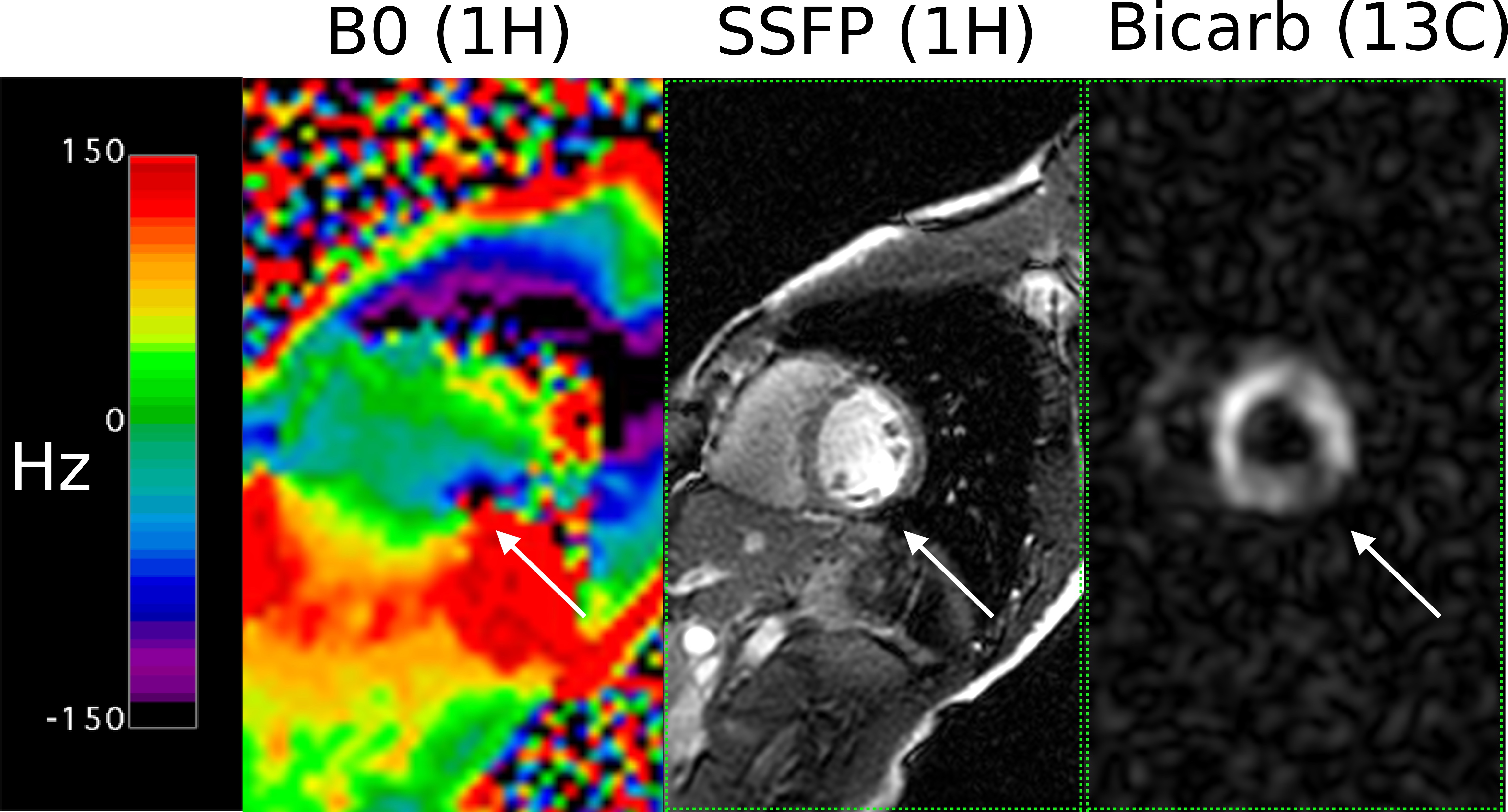 We evaluated multiple RF coil configurations for in-human ...