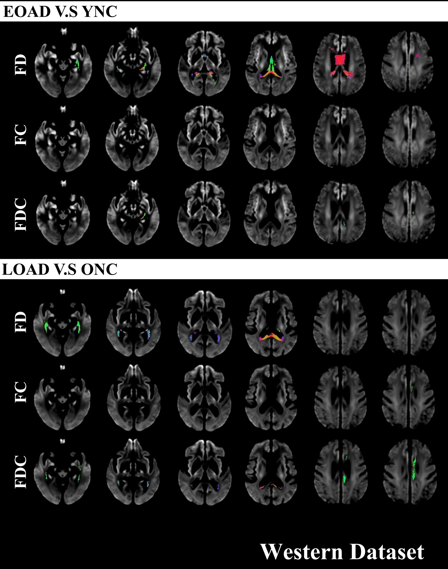 Distinct fibre-specific white matter reductions pattern in early- and ...