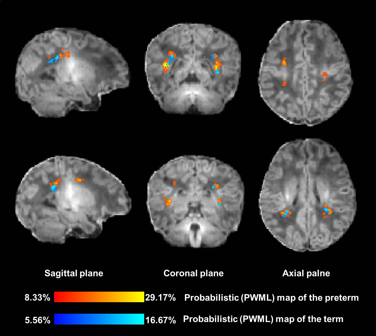 Figure 4 Comparison of probabilistic punctate white matter lesion (PWML ...