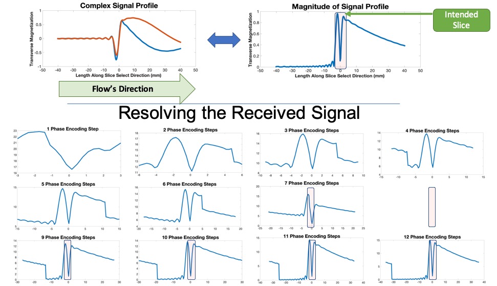 Slice Encoding for the Reduction of Outflow Signal Corruption in Cine ...